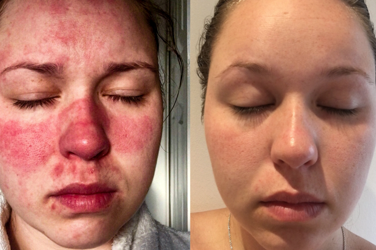 Rosacea Symptoms Woman With Skin Condition That Made It agony To 