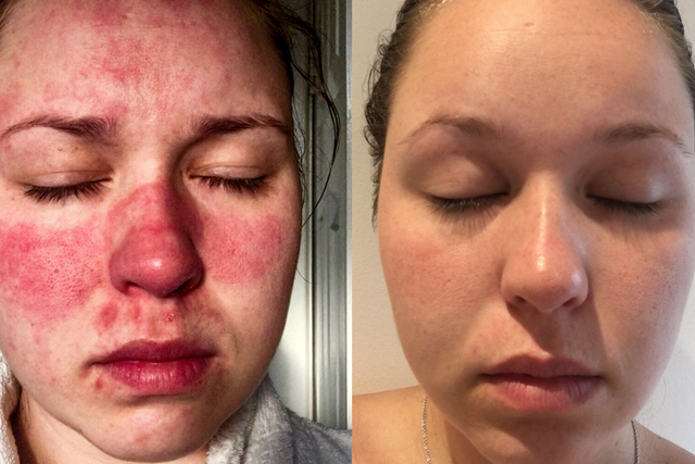 Jade discovered she had a skin condition, rosacea (Collect/PA Real Life)