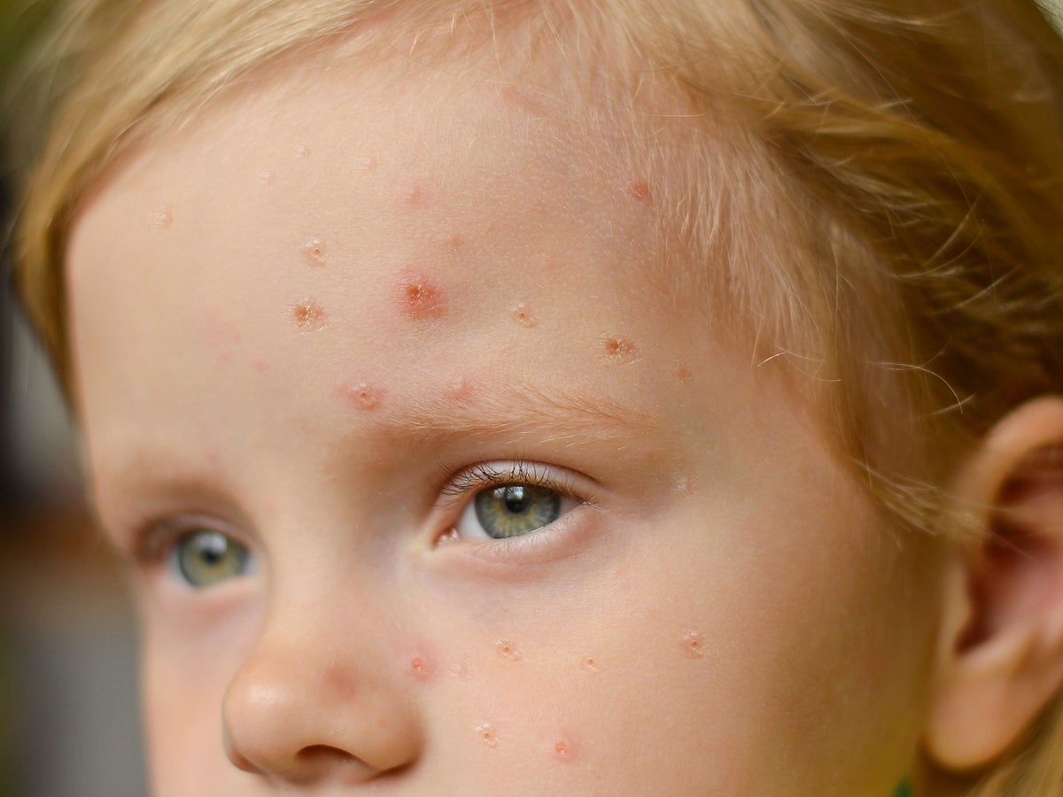 Scarlet Fever Symptoms To Look Out For And How To