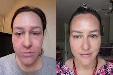 Mother whose eczema made it feel like her ‘skin cried’ reveals how she transformed her complexion