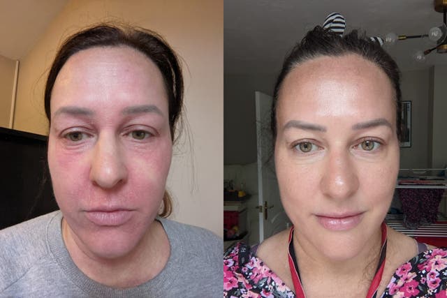 Before and after Natasha Liedl-McDowall healed her eczema (Collect/PA Real Life).