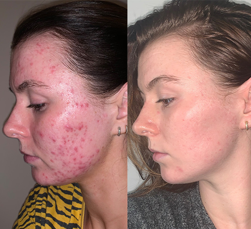 Molly’s skin after 8 months use of her personalised perscription, Dermatica.co.uk