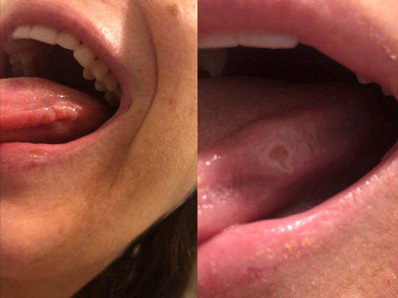 Roban Lampkin found sores on the inside of her mouth and tongue that made it hard to speak