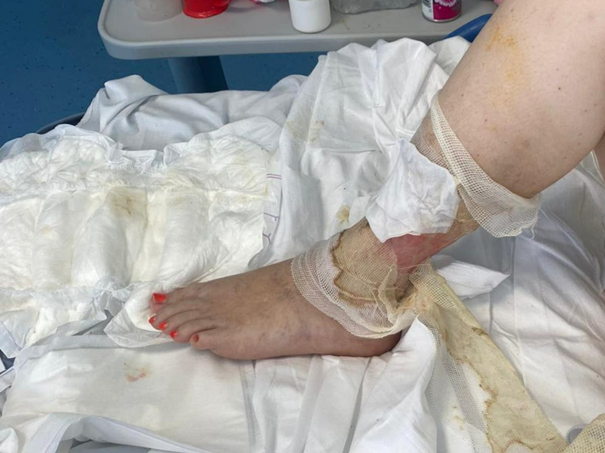 Mother nearly dies after 13-year-old bite turns into sepsis Mother nearly dies after 13-year-old bite turns into sepsis