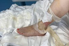 Mother nearly dies after 13-year-old bite turns into sepsis