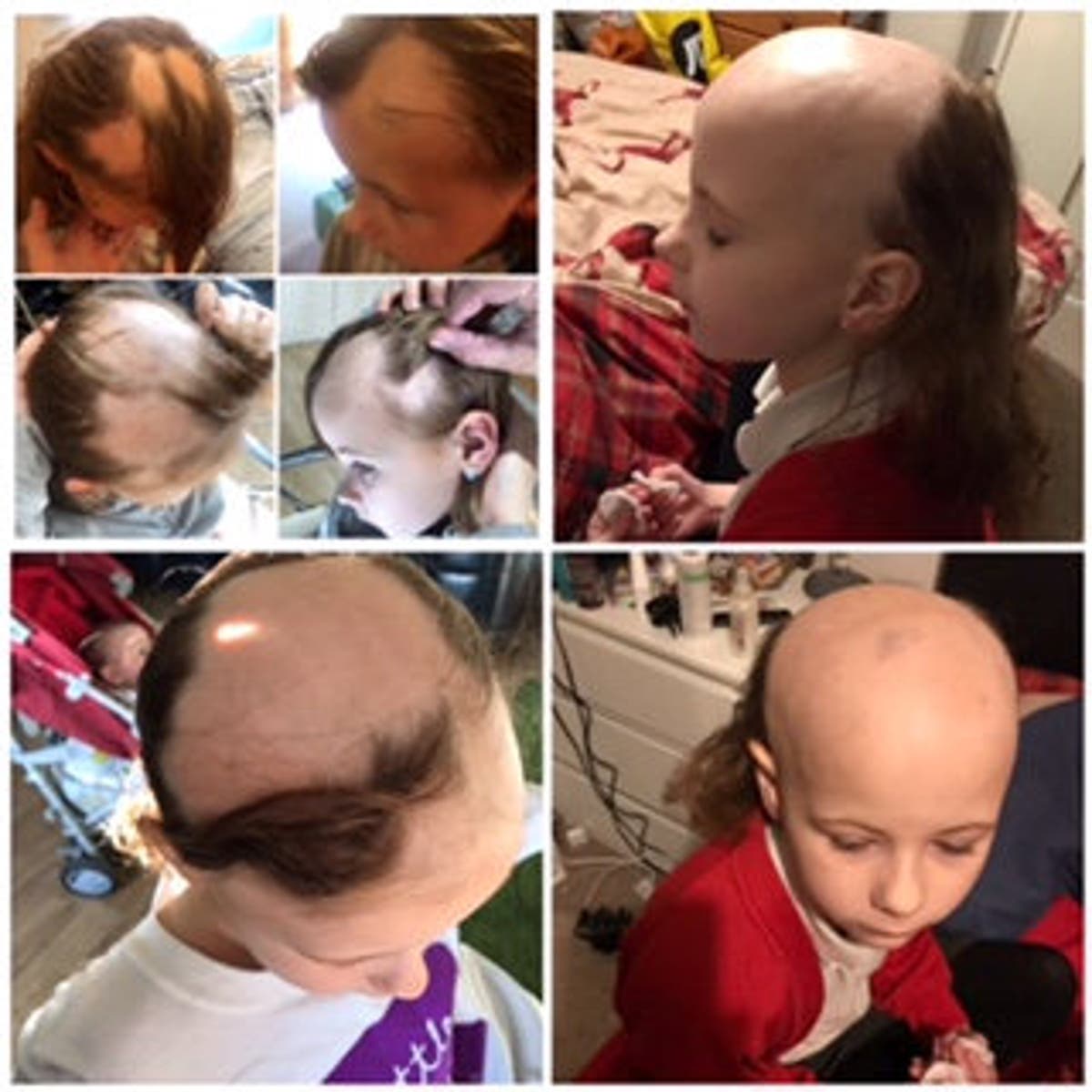 Alopecia areata: Halifax schoolgirl Bonnie Pullan who went bald due to bullying gets ‘life-changing’ treatment