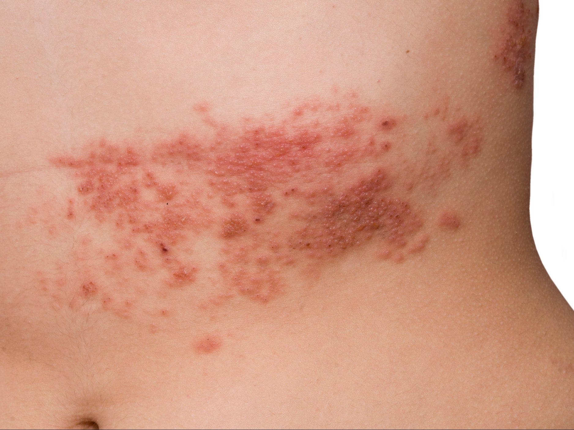 Ringe can cause a painful rash and can lead to serious problems including vision loss, hearing problems and scarring.