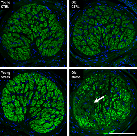 When the team investigated the optic nerve head of eyes treated with mild pressure elevation, they found that in the young optic nerve head, there was no sign of loss of axons. However, in the optic nerves of old animals, significant sectorial loss of axons was observed similar to the phenotype commonly observed in glaucoma patients