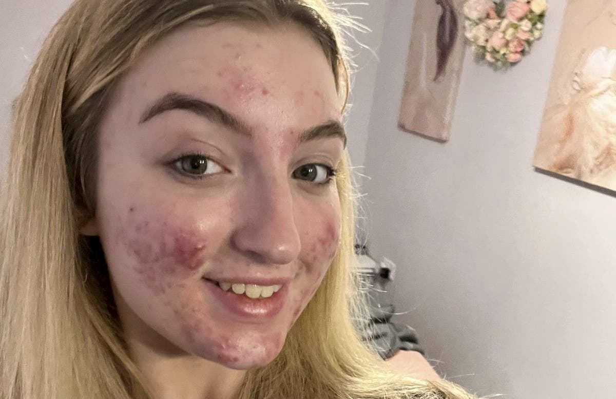 Beauty queen claims her Tiktok was shut down because of her acne