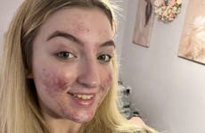 Beauty queen claims her Tiktok was shut down because of her acne