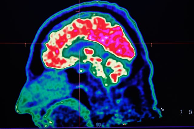 <p>A picture of a human brain taken by a positron emission tomography scanner, also called PET scan, is seen on a screen on January 9, 2019, at the Regional and University Hospital Center of Brest (CRHU - Centre Hospitalier Régional et Universitaire de Brest), western France</p>