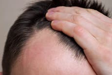 Drinking energy drinks accelerates hair loss for men, study finds