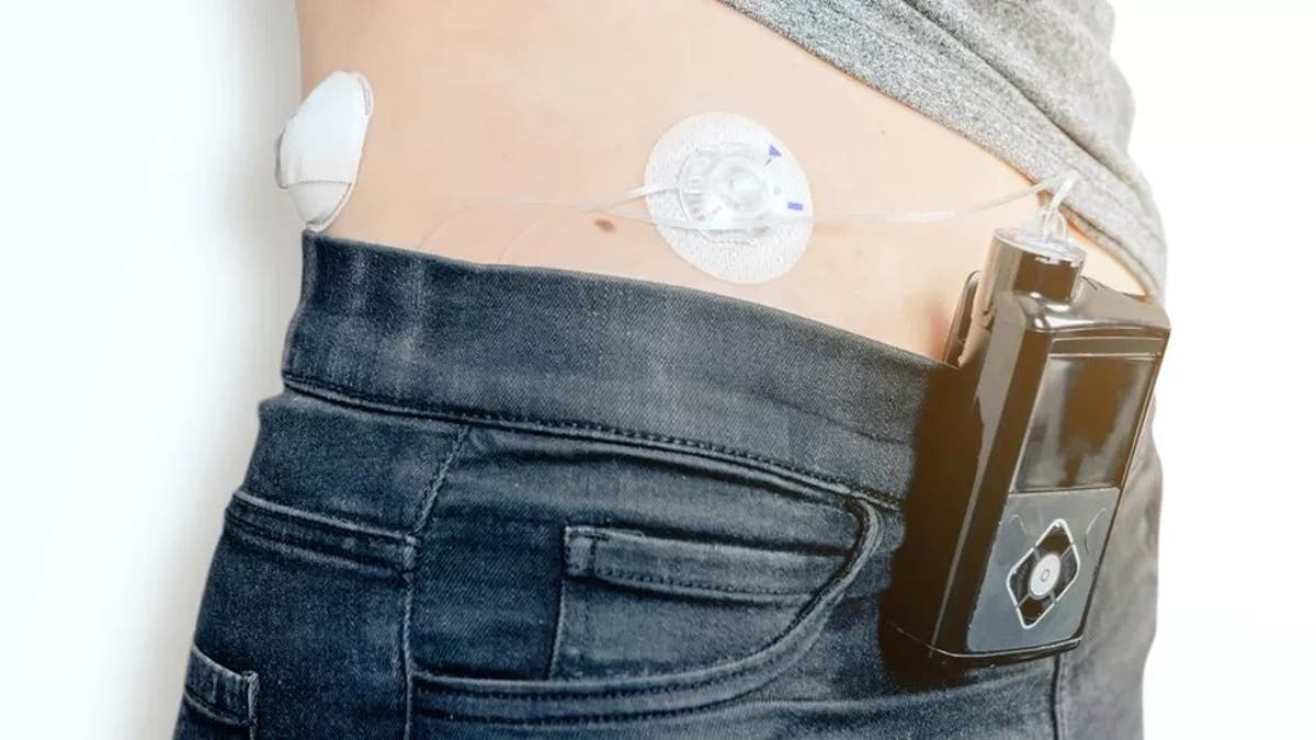 Diabetes breakthrough as life-changing artificial pancreas given NHS approval