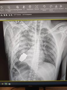 Surgeons ‘remove unexploded grenade lodged in Ukrainian soldier’s chest’