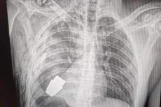 Surgeons ‘remove unexploded grenade lodged in Ukrainian soldier’s chest’