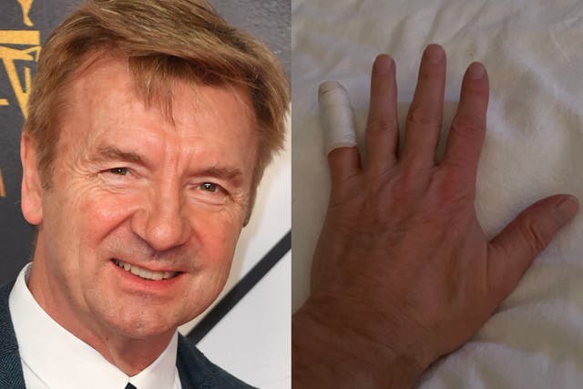 <p>Christopher Dean and his injured hand</p>