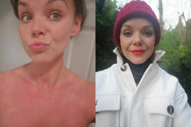 Tammy Rose Bringloe wants to raise awareness of cold urticaria (Collect/PA Real Life)