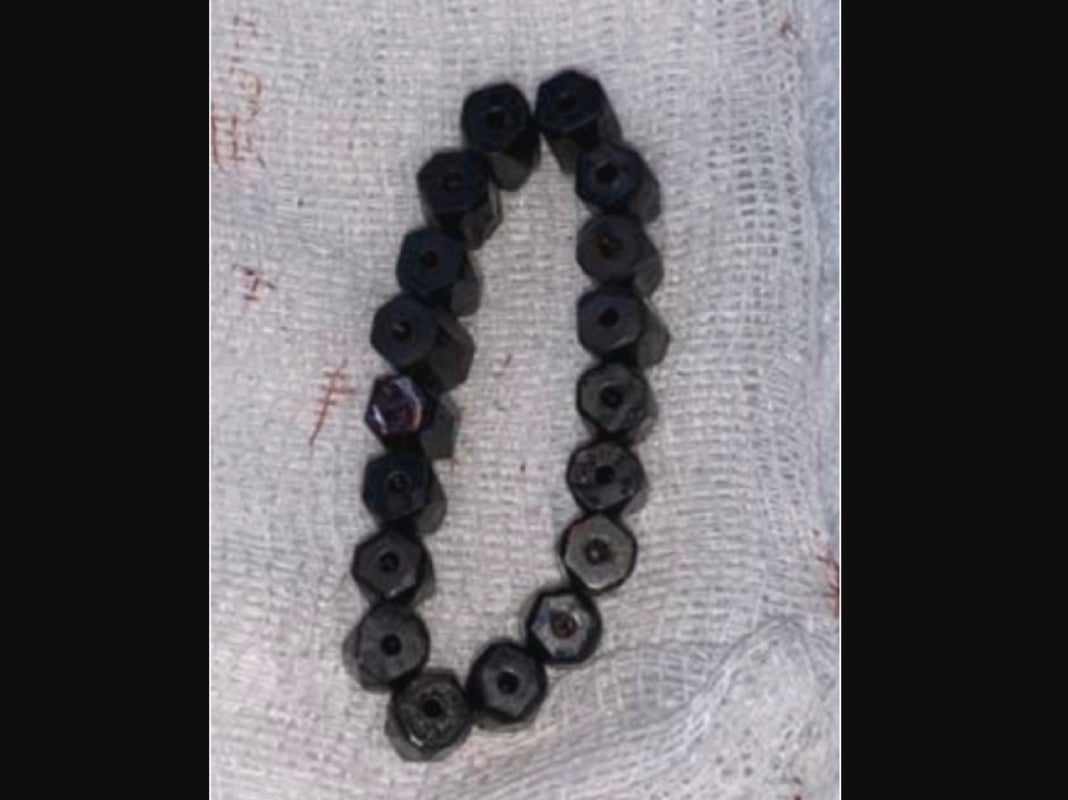 A four-year-old ingested multiple magnetic beads