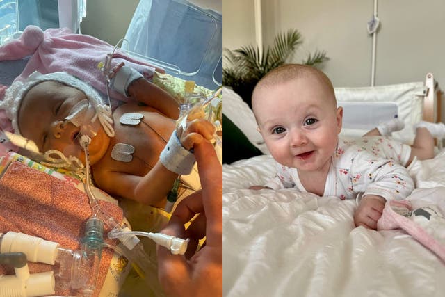 Baby Connie in intensive care and now (Collect/PA Real Life)