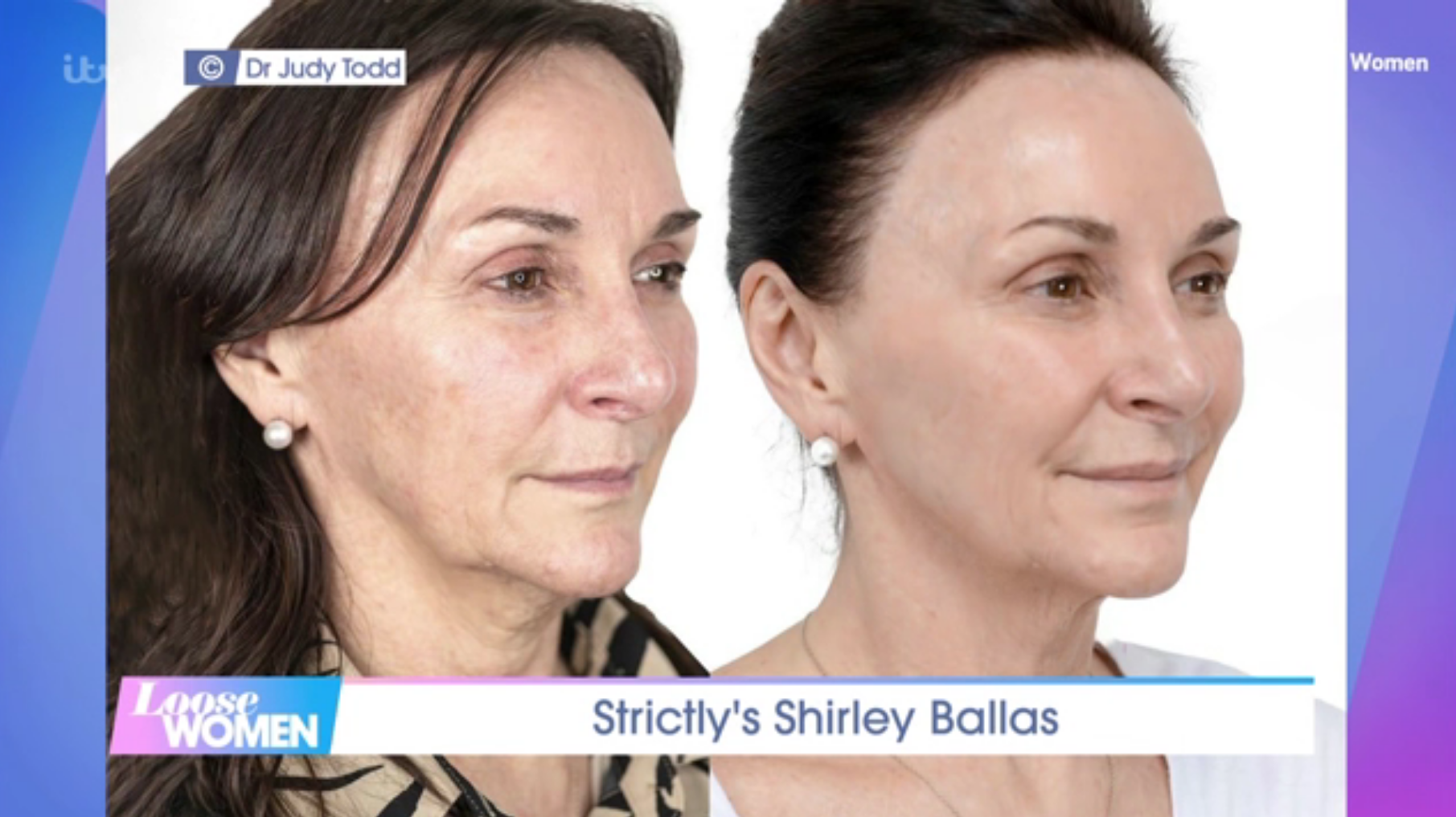 A composite aired on Loose Women shows Shirley Ballas’ before and after facelift photos