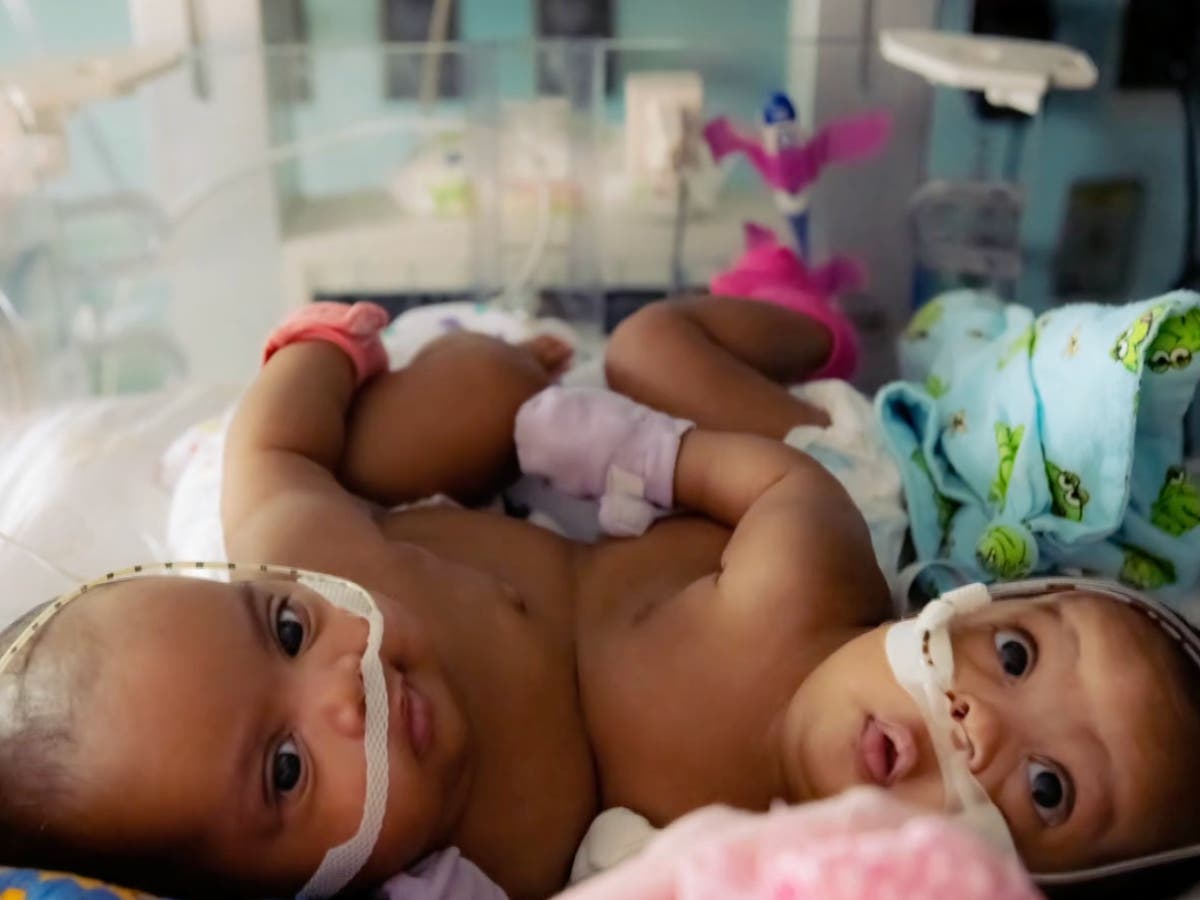 Conjoined twins were separated in a ‘historic’ 11-hour operation at a Texas hospital