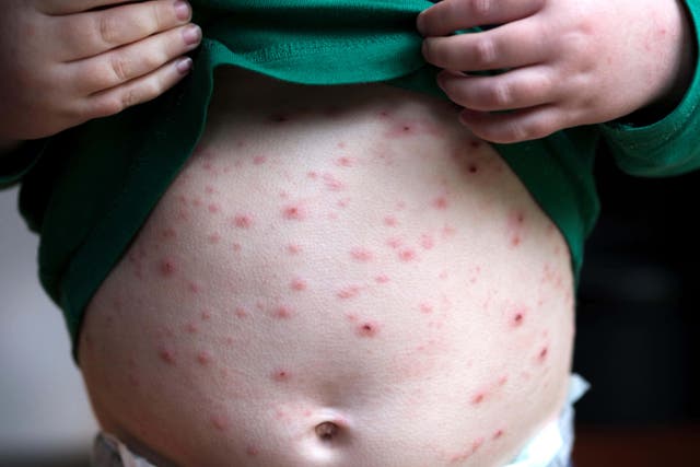 A child infected with chickenpox (Alamy/PA)