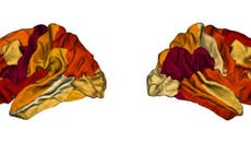 Obesity can trigger Alzheimer’s disease, new study suggests