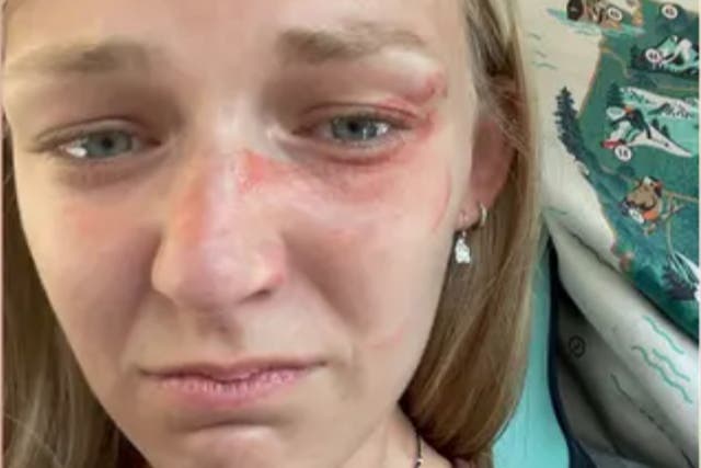 <p>A photo of Gabby Petito showing blood and bruises on her face just before her and her ex-fiance Brian Laundrie were stopped by Moab police officers investigating a domestic abuse call</p>