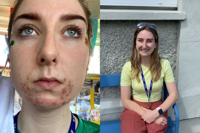 Before and after Kate Prendergast cleared her acne (Collect/PA Real Life)