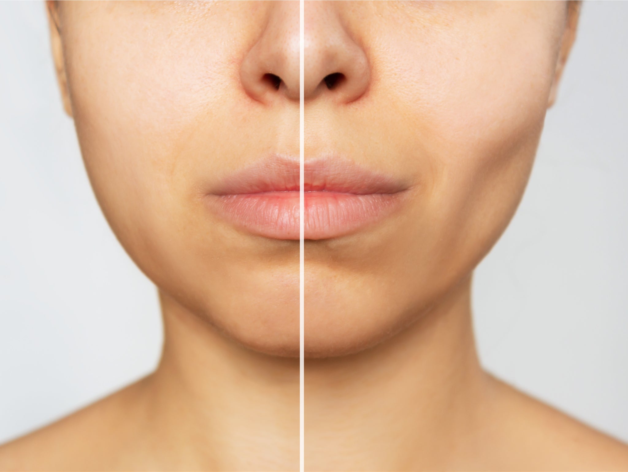 Doctor explains why he refuses to offer buccal fat removal to clients The Independent image