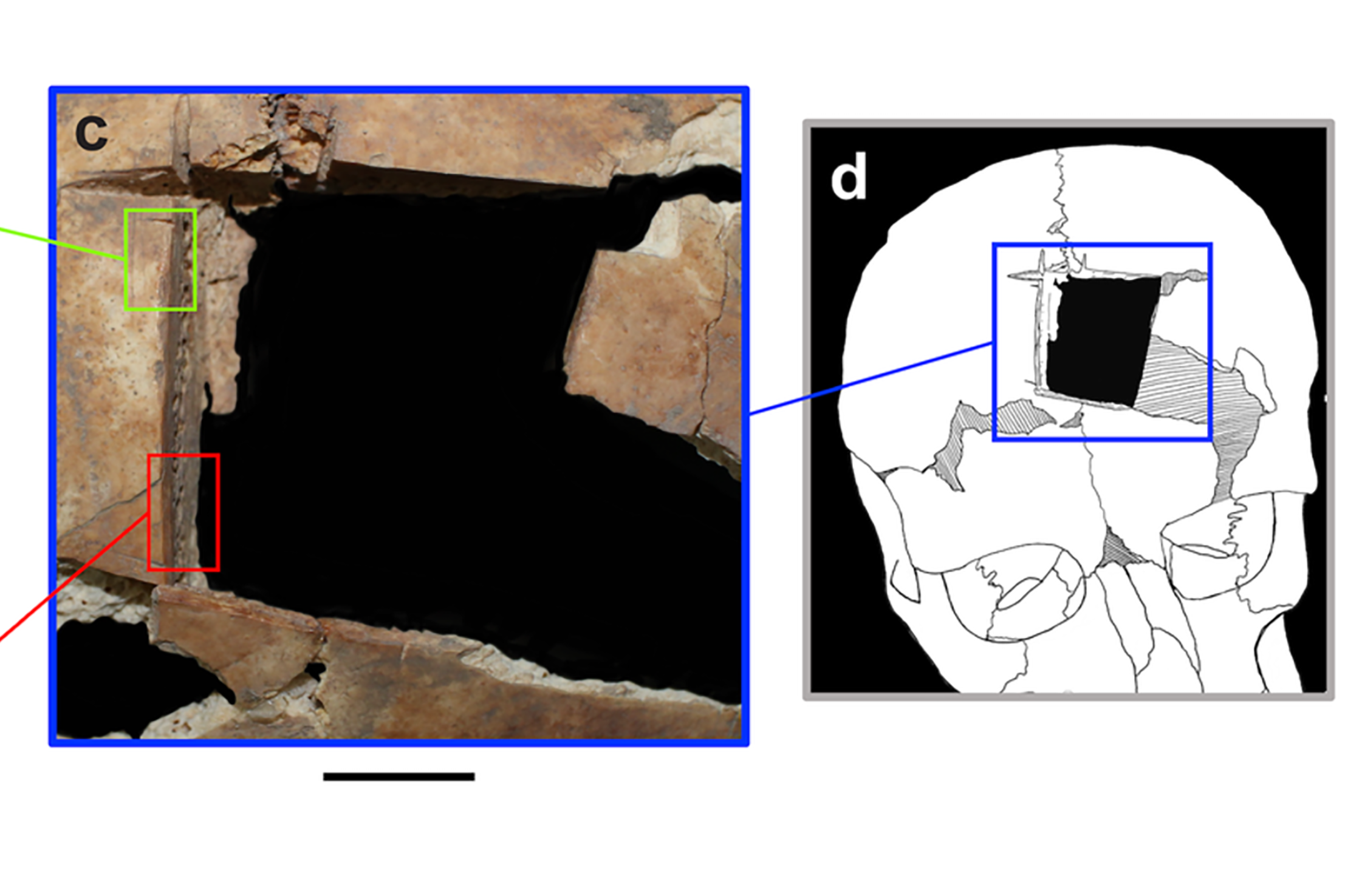 Photos showing skull with a square-shaped hole after surgery. The remains were found in Tel Megiddo in Israel (Kalisher et al/Plos One)
