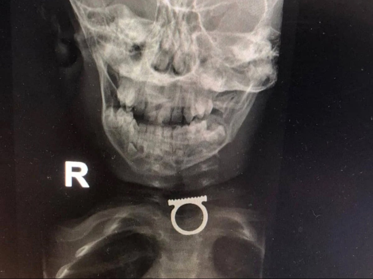Doctors remove ring from toddler’s throat after two year old swallowed mother’s jewellery