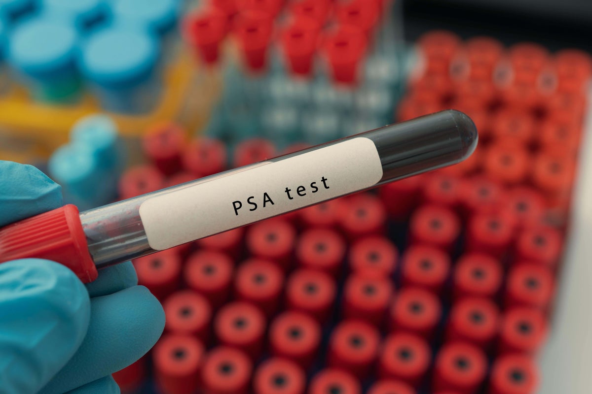 Psa Uk Harms linked to prostate cancer screening ‘reduced by medical advances ...