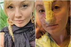 Woman’s nose ripped off by pet dog scared of her teeth whitening