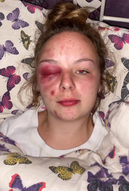 Image released of the injuries suffered by Eleanor Williams, which were self-inflicted