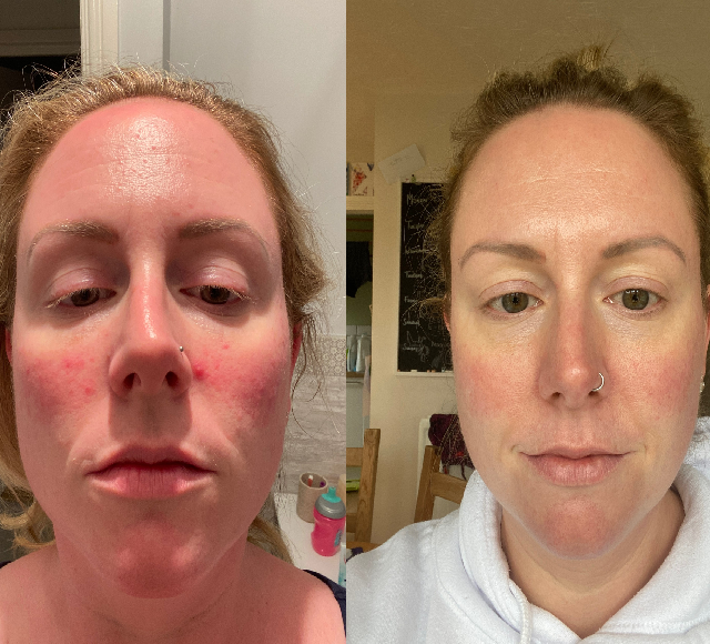 Eve’s skin after 2 months on her treatment plan, Dermatica.co.uk