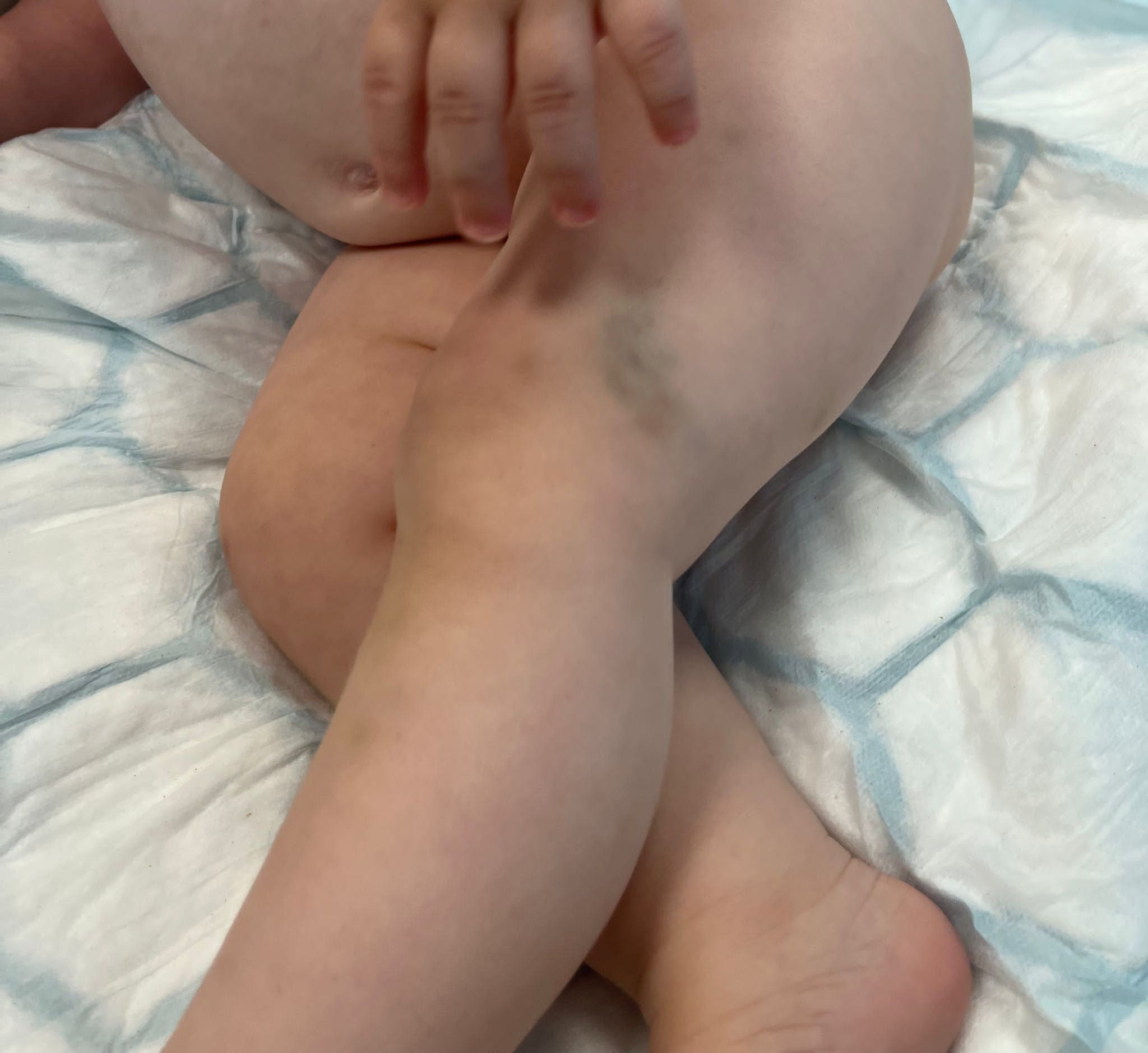 Mystery bruises on baby boy Bailey KilbaneÕs legs