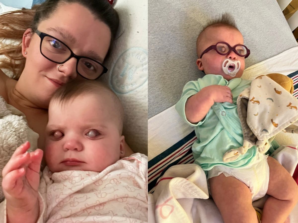 Mother documents story of baby born with bubble on eyeball from glaucoma as she says infant is ‘thriving’