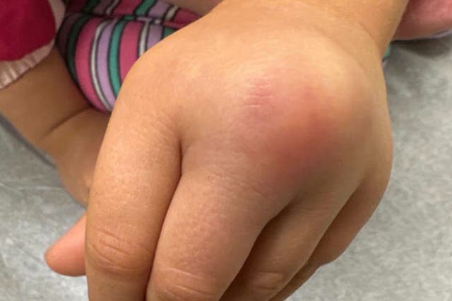 <p>A ‘bump' on the toddler’s hand slowly grew and then developed a reddish-bluish hue</p>
