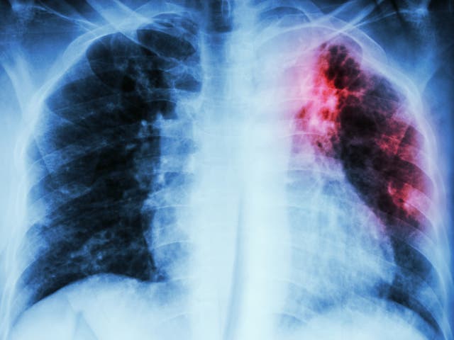 <p>Tuberculosis deaths have risen for the first time in decades, according to a World Health Organisation report</p>