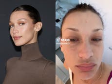 Bella Hadid shares update on Lyme disease diagnosis after suffering from tooth infection