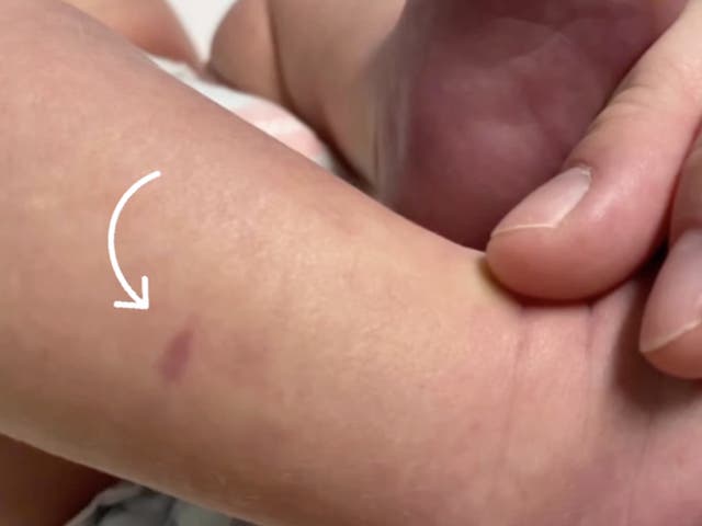 <p>The new mum first noticed the small mark did not turn white when she applied pressure </p>