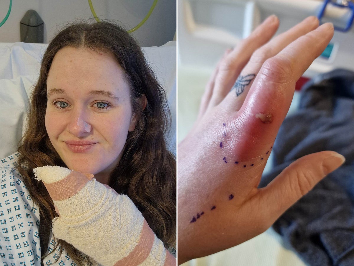 Woman forced to have surgery after ‘spot’ turned out to be false widow spider bite