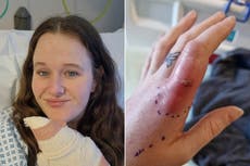 Woman forced to have surgery after ‘spot’ turned out to be false widow spider bite