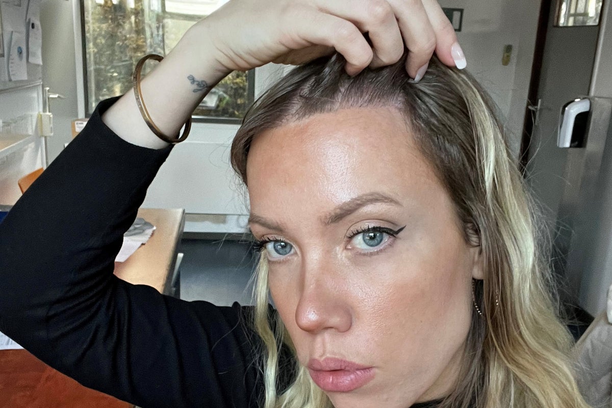 Woman who had hair transplant to cover 'big forehead' reveals results | The  Independent