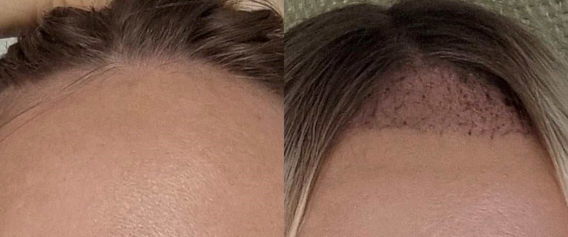 Woman who had hair transplant to cover 'big forehead' reveals
