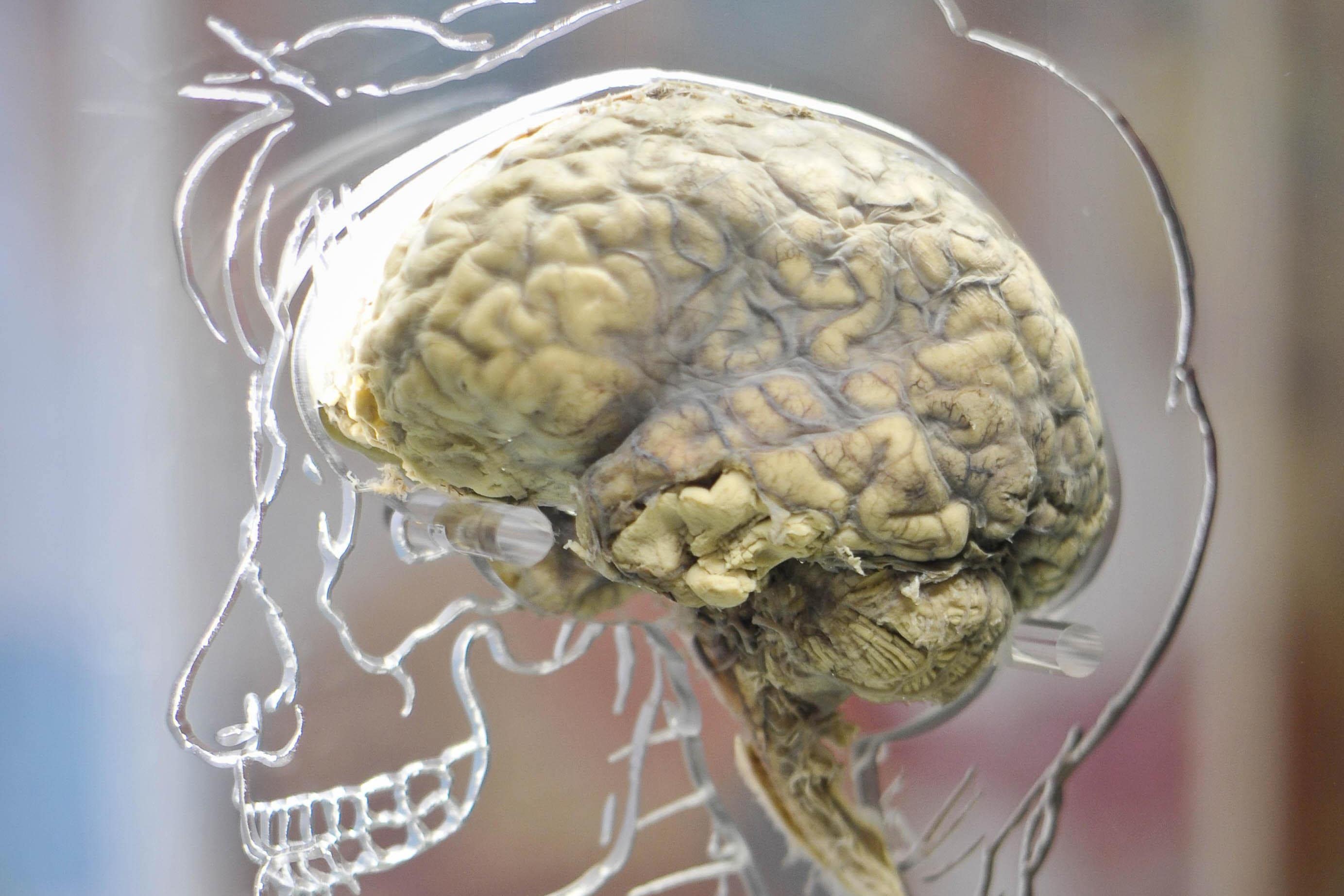 Nearly half of people with concussion show brain injury symptoms six months later (Ben Birchall/PA)