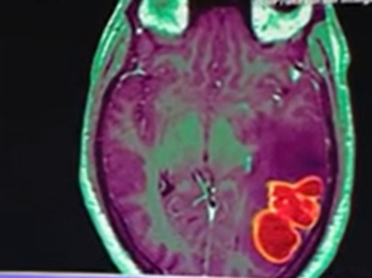 Mysterious cluster of child brain infections on the rise in southern Nevada