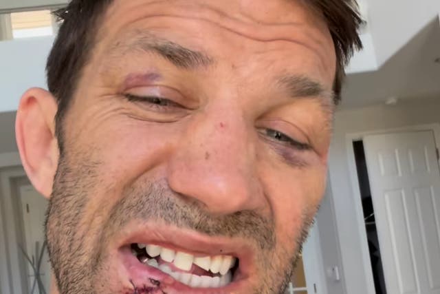 <p>Former UFC champion Luke Rockhold shows off his broken tooth</p>