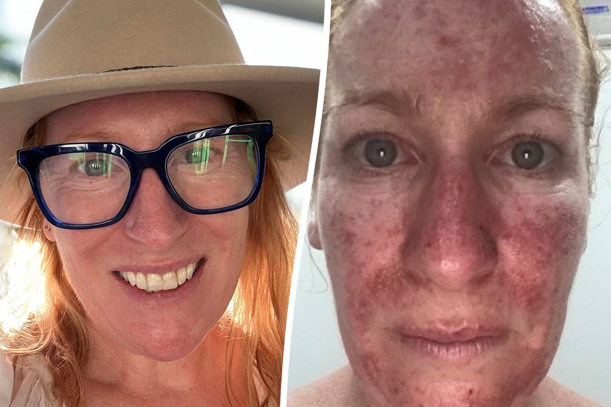 Mother left ‘looking like Freddy Krueger’ reveals first skin cancer warning sign